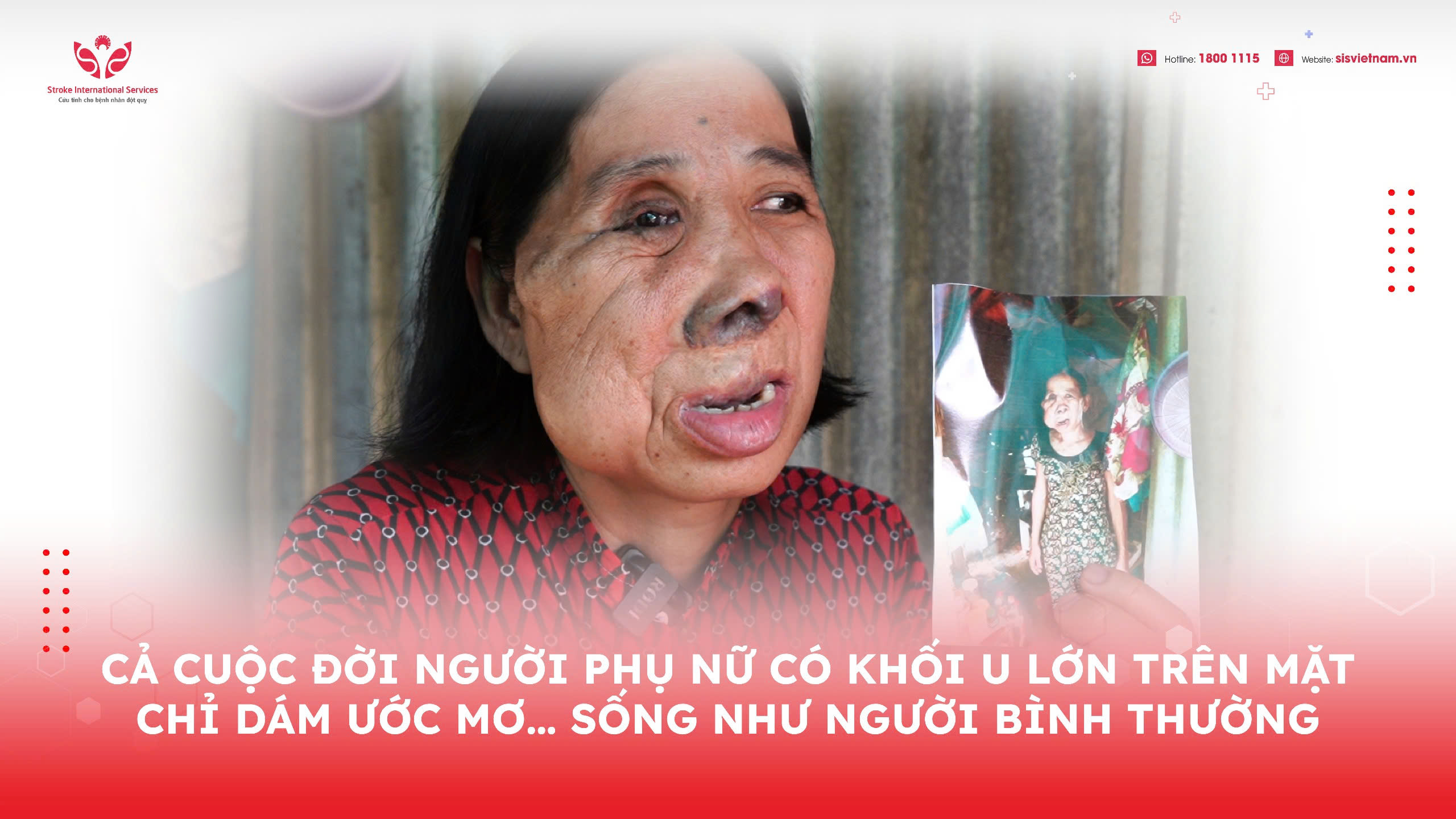 CẢ CUỘC ĐỜI NGƯỜI PHỤ NỮ CÓ KHỐI U LỚN TRÊN MẶT CHỈ DÁM ƯỚC MƠ… SỐNG NHƯ NGƯỜI BÌNH THƯỜNG